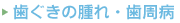 歯ぐきの腫れ・歯周病