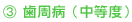 3歯周病(中等度)