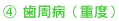 4歯周病(重度)
