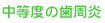 中等度の歯周炎